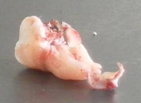 A difficult lower jaw wisdom tooth to extract. This came out in 3 pieces. Note the decay at the crown end (left) and the hooked root (right).