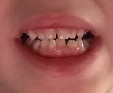 My son's mouth was too small for the adult teeth to come in properly. A lateral incisor and both canines needed to be pulled out
