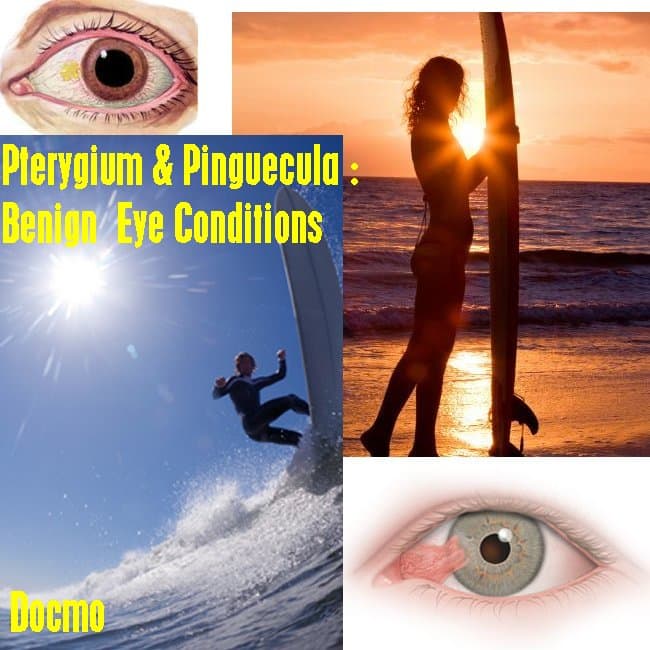 What Is Surfer S Eye Pterygium And Pinguecula Explained Youmemindbody