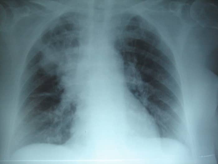 Aspiration pneumonia is visible on a chest x-ray (although not always right away).