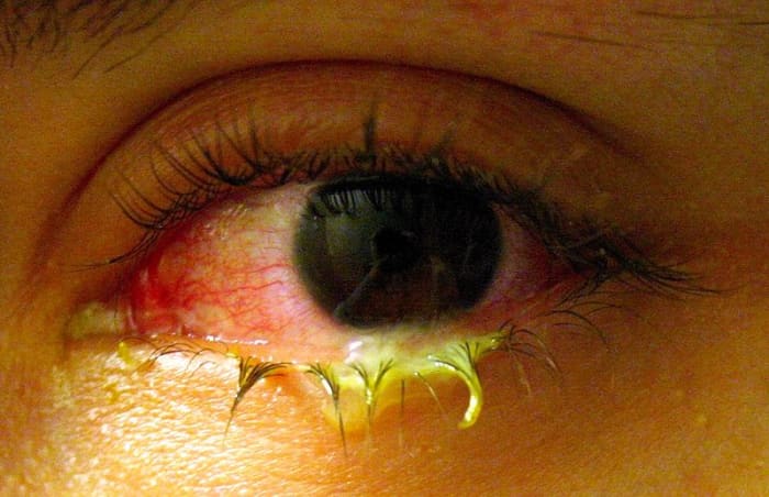 Bacterial "pink eye." Bacterial conjunctivitis is usually associated with a very purulent discharge.