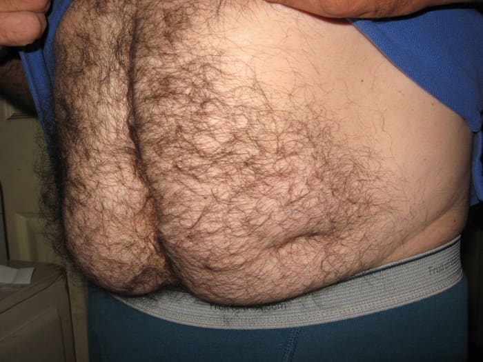 You can still see where the stoma hole was, 24 years after colostomy surgery. The midline incision divides the tummy in half, too.