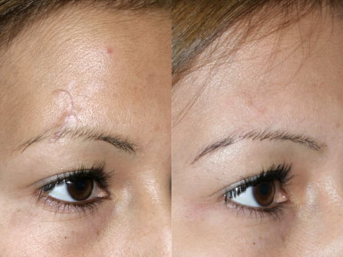 You can rid yourself of scar tissue (or reduce it significantly) with a few simple techniques and a homemade remedy using natural carriers and essential oils.