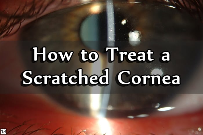 One of the most common injuries seen in an ophthalmologist’s office is a scratched cornea, also known as a corneal abrasion.