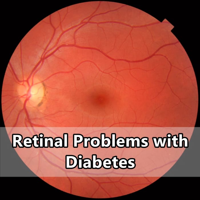 Retinal Problems With Diabetes - HealthProAdvice