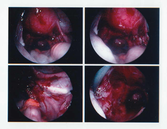Endometriosis, large cysts, lesions and adhesions covering the inner surfaces of my abdomen.