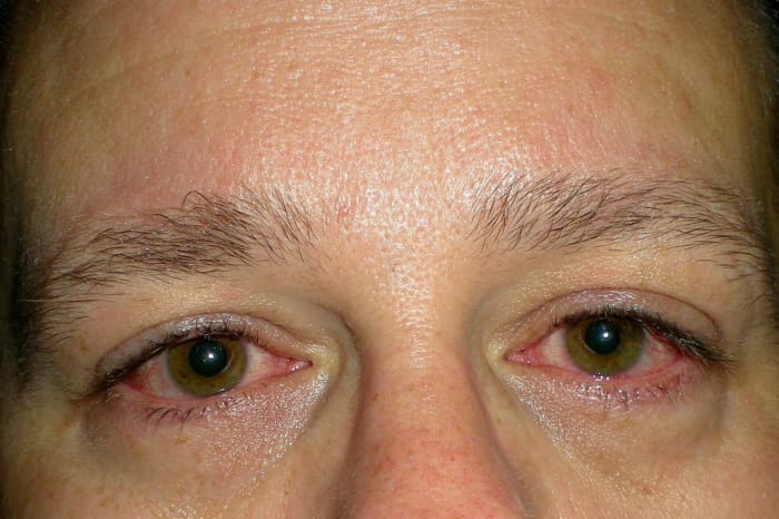 Itchy, red, and watery eyes are often associated with allergies or hay fever, but they can also indicate problems with your thyroid