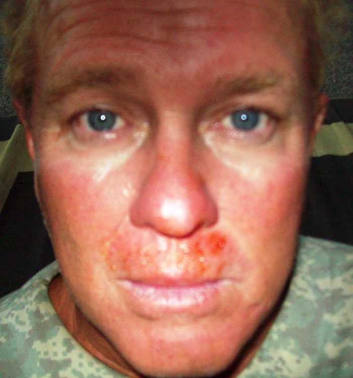 What Are the Causes of Frequent Bloody Noses? HubPages