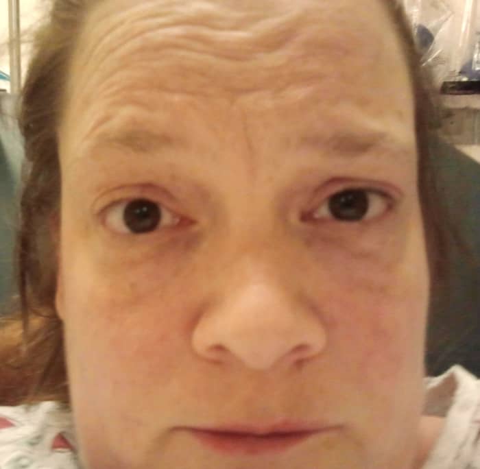 This person believes that her gallbladder is trying to kill her. Don't try this at home, folks. (Yes, this was after the morphine and no, I do not know how one eye got higher than the other.)