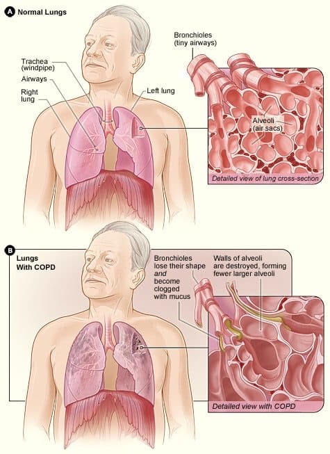 Healthy lung tissue versus lung tissue from a person with chronic bronchitis and emphysema. One or both of these conditions are present in COPD.
