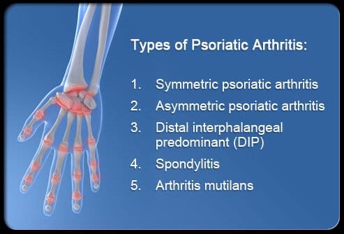 Types of psoriatic arthritis