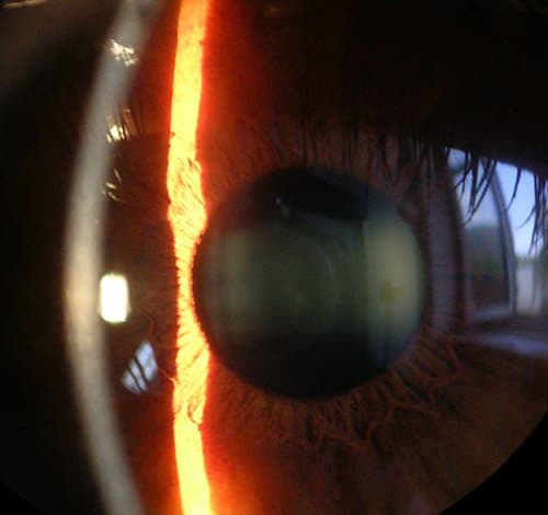 The first beam of light from the left is the cornea, the second beam is on the iris in the anterior chamber.