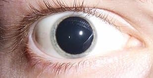 An eye dilated with a cycloplegic drop
