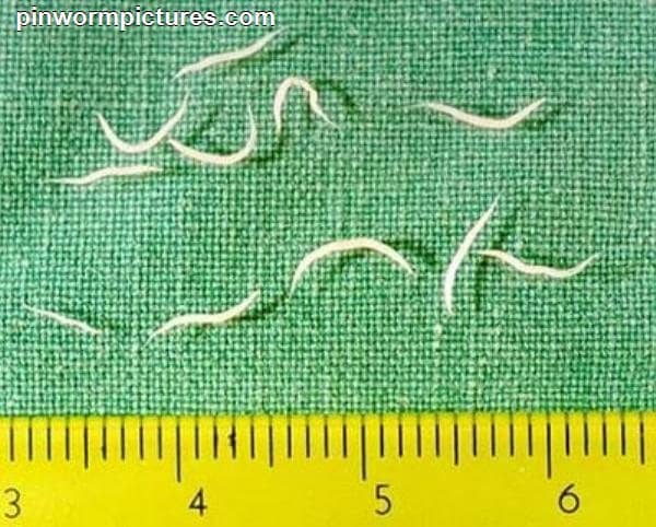 How to Get Rid of Pinworms: A Mother's Story - Patient's Lounge