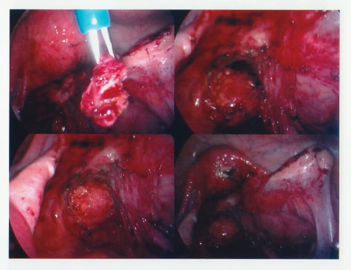 After 3 months of menopause, it was safe to operate. You can see the huge number of lesions and chocolate cysts more clearly with a reduced blood supply.
