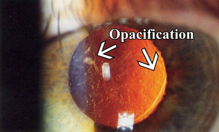 Posterior capsular opacification. The arrows are pointing to some of the opacification; however, the entire capsule is affected.
