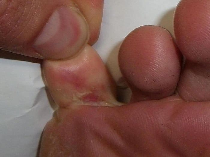 Interdigital athlete's foot between the toes and spreading around the side of foot.
