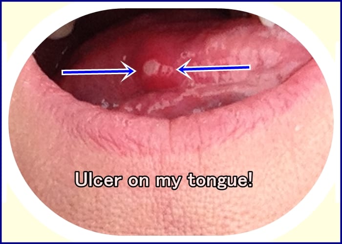 My own problems with mouth ulcers prompted me to research home remedies and products that worked - and to share them in this article.