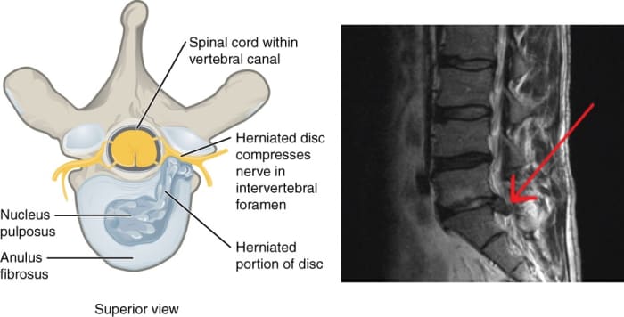 Illustration of a vertebra with a herniated disk and an MRI (magnetic resonance imaging) picture of a real herniation