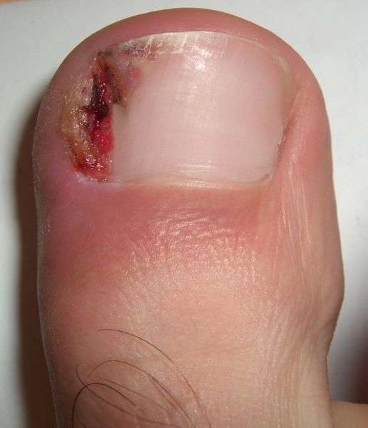 Bloody ingrown toenail