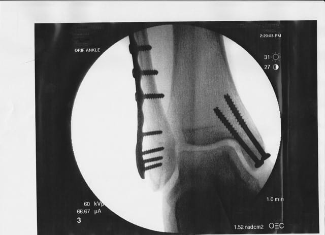 I broke three bones in my lower leg. I required 10 screws, 1 plate, and 3–4 months of rest and rehabilitation.
