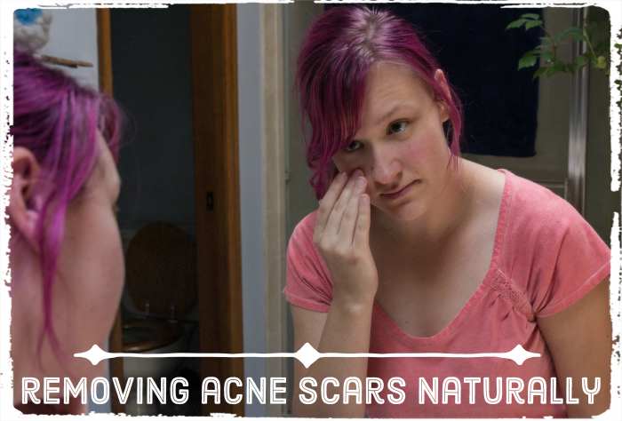 Follow these simple, at-home remedies to minimize and lighten the scars left behind by acne.