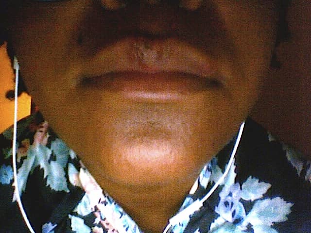 My own picture of a previous cold sore outbreak. The wound is on the left side of the picture, in its scab stage. The blemish on the right side of the picture is a scar from a previous outbreak that occurred not too long before the current one.