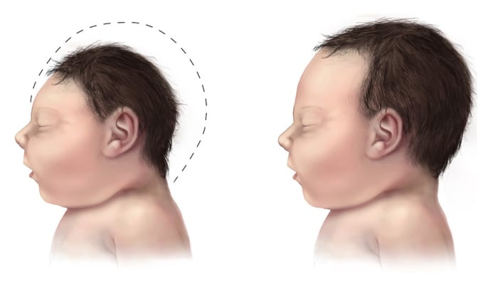 A side-view illustration of a baby with microcephaly (left) compared to a baby with a typical head size.