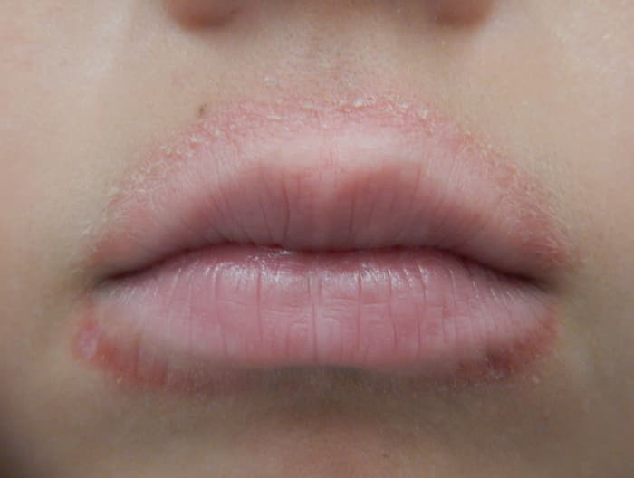 Rash Under Lip Child