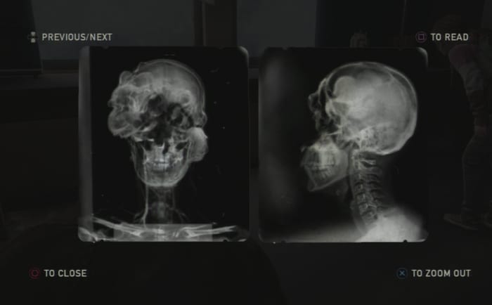 Found in the University, this X-Ray shows the idea of what the fungus actually does to the human brain to create "clickers".