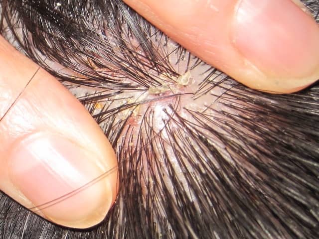 Natural and Alternative Treatments for Scalp Psoriasis - RemedyGrove