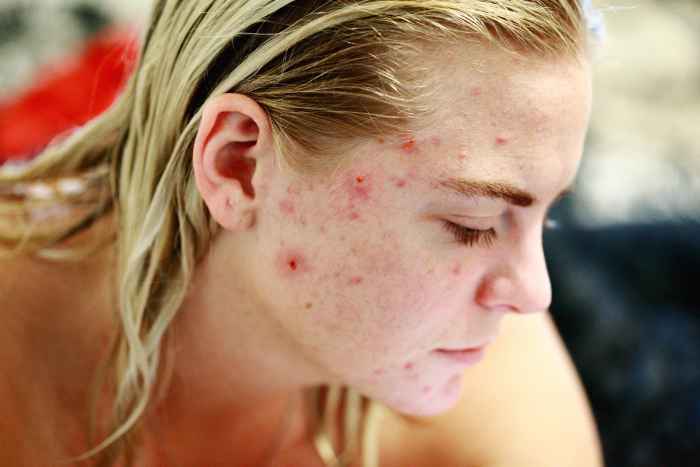 Picture posed by model, as my daughter did not want a picture of her acne on the internet.
