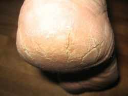 help-for-cracked-bleeding-heels