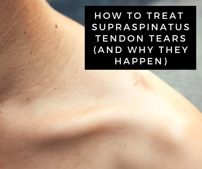 a-guide-to-supraspinatus-tendon-tears-rotator-cuff-injury-youmemindbody