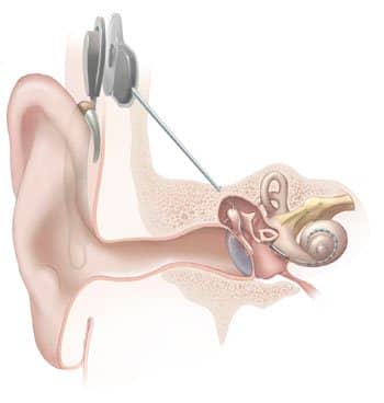 Illustration of cochlear implant from the National Institute on Deafness and Other Communication Disorders at the National Institutes of Health.