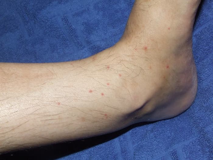 Flea Bites on Humans Symptoms, Treatment, and More Dengarden