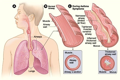 During an asthma attack, airways narrow and fill with mucus. Mold spores are a common trigger for asthma. Aspergillus in the airways can make asthma worse.