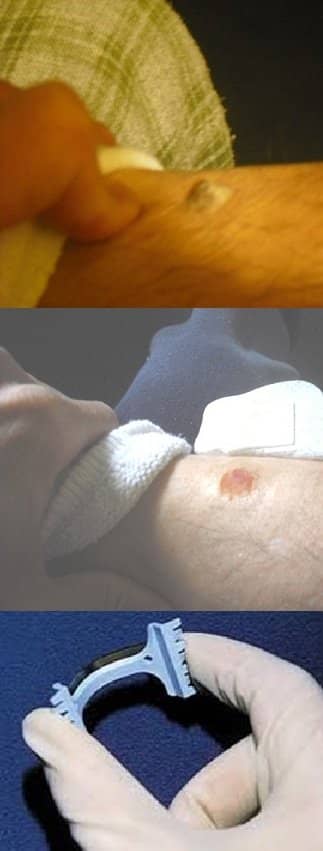 Recently, I had another skin growth on my right leg just above the foot. The doctor diagnosed the growth as SK right away and proceeded to cut it out.