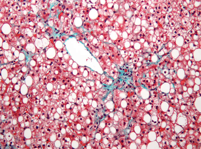 A stained liver section from someone suffering from non-alcoholic fatty liver disease. The red cells are liver cells; the white, oval areas are cells containing fat; and the green fibers show the beginning of liver fibrosis.