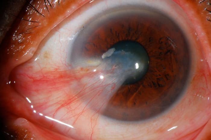 Left unchecked, a pinguecula can cross into the colored portion of the eye and interfere with vision. This condition is called pterygium, as shown in this severe case.