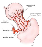 Avascular necrosis of the femoral head. Illustration of the normal circulation of the femoral head, viewed from the posterior approach. The posterior-superior retinacular arteries provide the major blood supply to the epiphysis. They traverse the fem