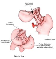 Avascular necrosis of the femoral head. Illustration demonstrating that the blood supply to the femoral head is compromised by subcapital femoral fractures or slipped capital femoral epiphysis. As the epiphysis or femoral neck separates from the femo