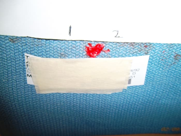 This is a photograph of the herniated disc material removed during my son's microdiscectomy. I am assuming the 1 and 2 markings represent an inch.