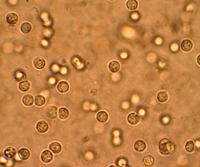 These are white blood cells in the urine of someone suffering from a urinary tract infection. The cells are part of the immune system.