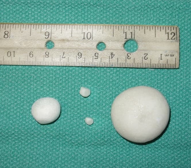 These are struvite stones from a dog's urinary bladder. The same stones form in humans during a Proteus mirabilis infection