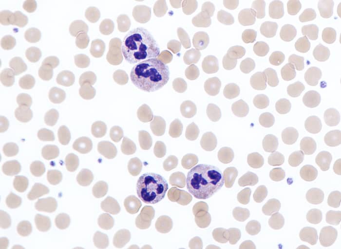 The appendix population of neutrophils (a type of white blood cell) increases significantly during appendicitis. The lobed structure in these stained neutrophils is the nucleus.