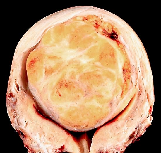 This hysterectomy specimen shows a large, solitary leiomyoma in the fundus, distoring the endometrial cavity into a Y shape by splaying and pressing it downwards.