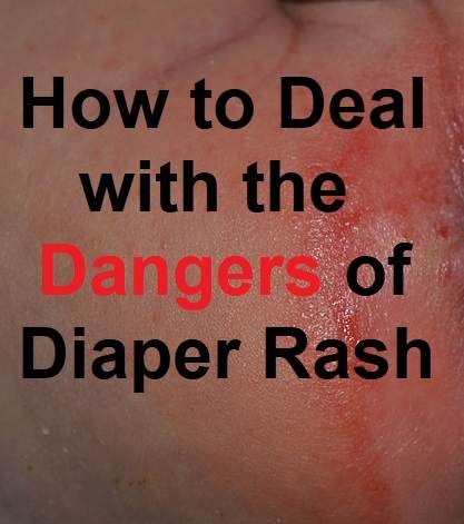 Most times diaper rash is uncomfortable for your baby but doesn't represent a risk to her health. However, it can be a sign of more serious conditions which parents should know about