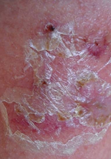Microbial infection eczema presents as a persistent flakiness of the skin and a sore rash. In infants it may be mistaken for diaper rash and so go untreated. If in doubt, see a doctor without delay