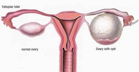 Ovarian cysts are generally benign, but if they don't go away on their own, they can become very large and painful.